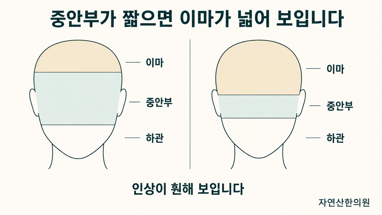 중안부가 짧아지면서 이마 비율이 상대적으로 넓어 보이는 원리를 표시한 얼굴 비율 도해