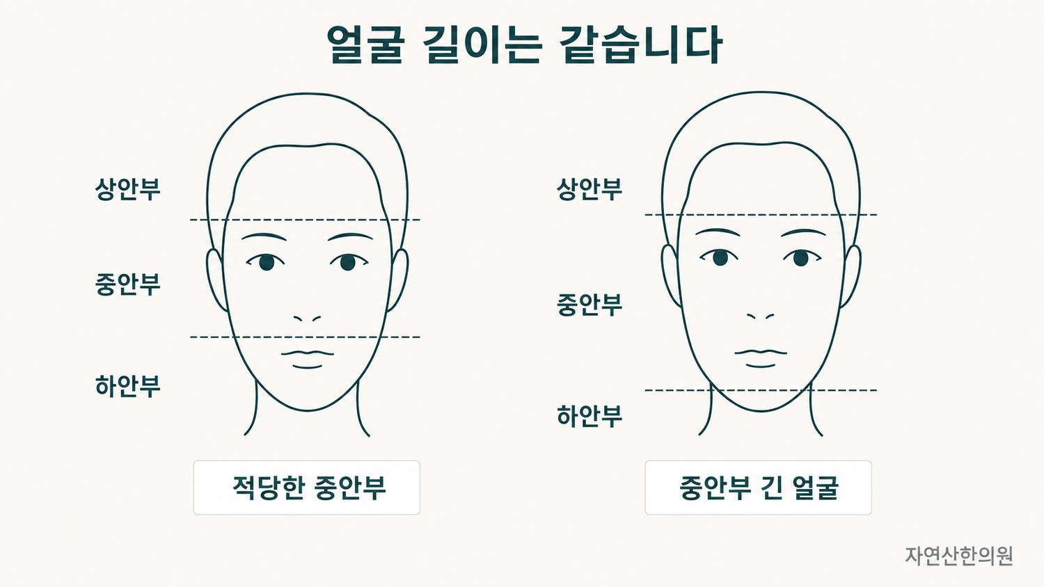 적당한 중안부의 얼굴과 중안부 긴 얼굴을 같은 얼굴 길이 조건에서 나란히 비교한 도해