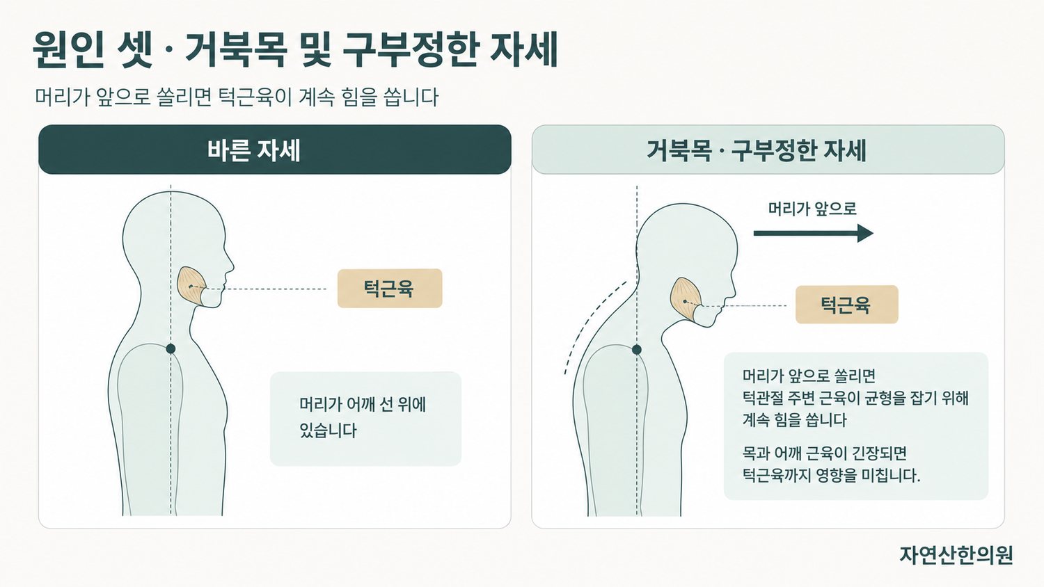 바른 자세와 거북목 자세에서 턱근육이 받는 부하 차이를 비교한 체형 도해