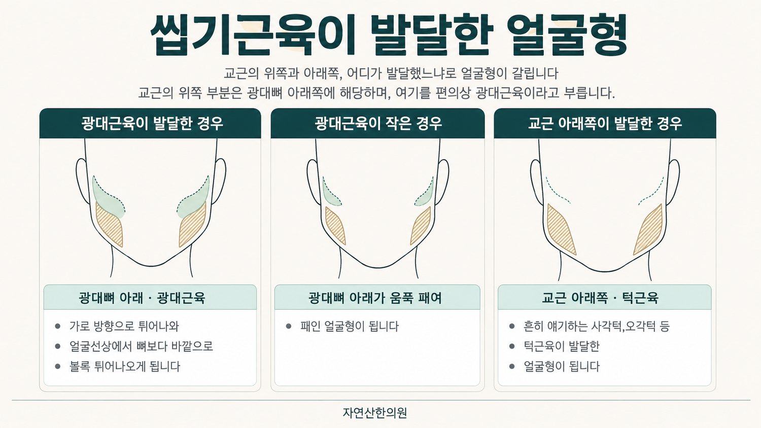 광대근육이 발달한 경우, 광대근육이 작은 경우, 교근 아래쪽이 발달한 경우 세 가지 얼굴형을 나란히 비교한 도해