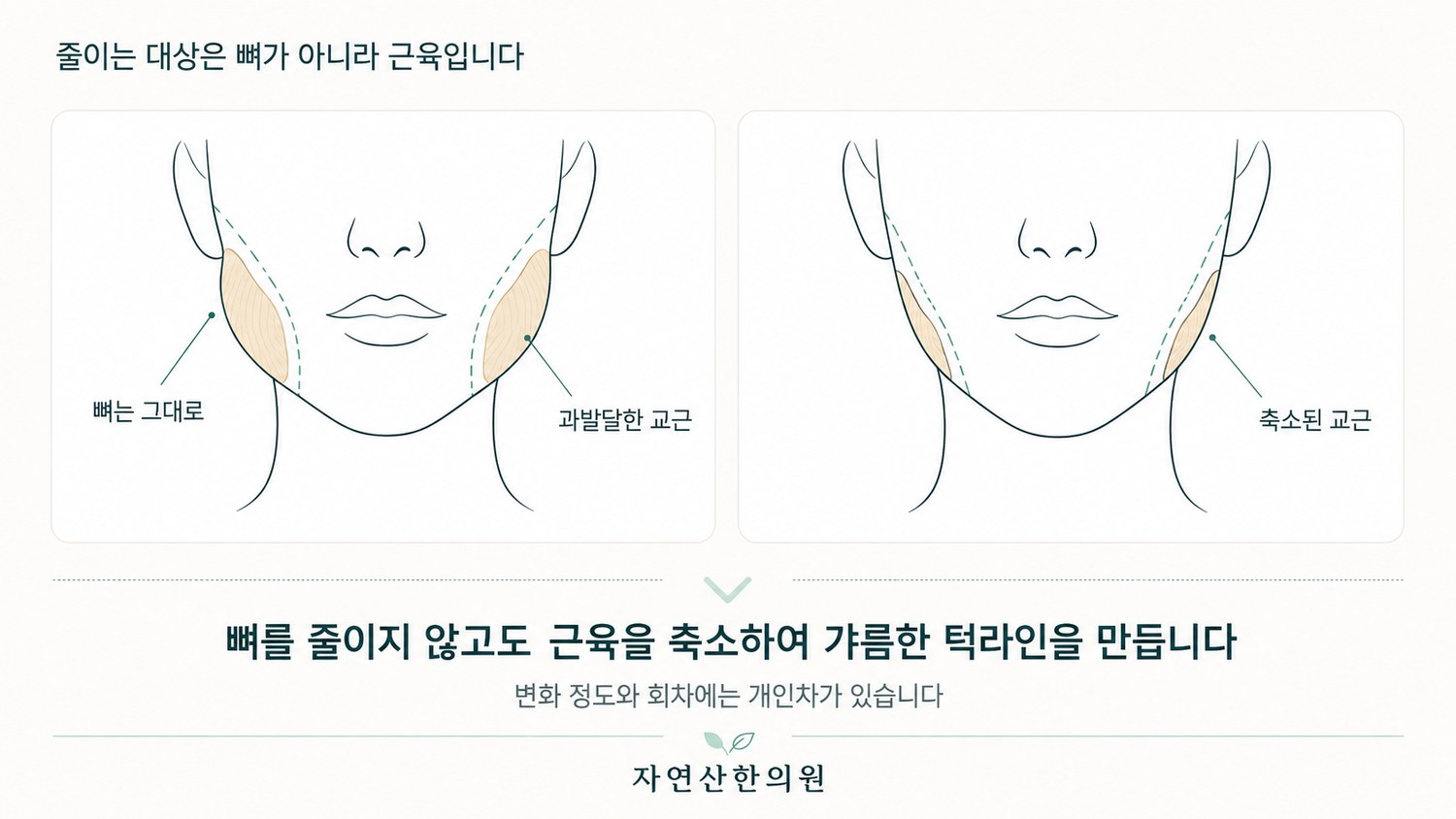 뼈는 그대로 두고 과발달한 교근 부분만 축소해 턱라인이 달라지는 구조를 표시한 도해