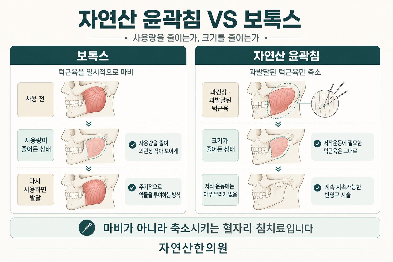 턱근육 사용량을 줄이는 보톡스 방식과 과발달된 부분만 축소시키는 자연산 윤곽침 방식의 비교 도해