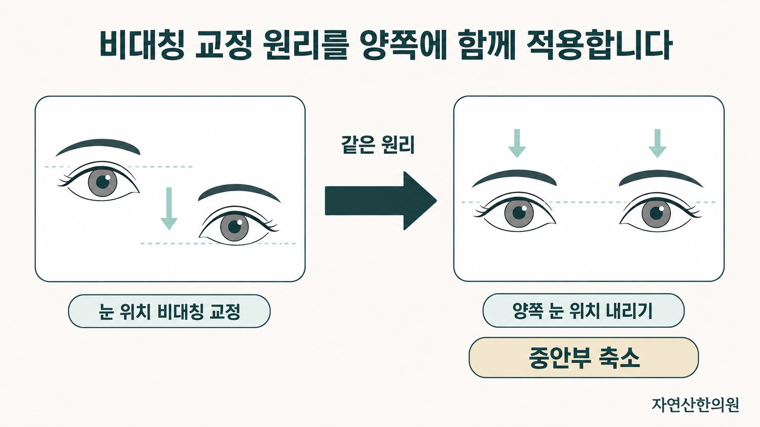 한쪽 눈 위치 비대칭 교정 원리가 양쪽 눈 위치 내리기로 확장되는 과정을 화살표로 표시한 개념 도해