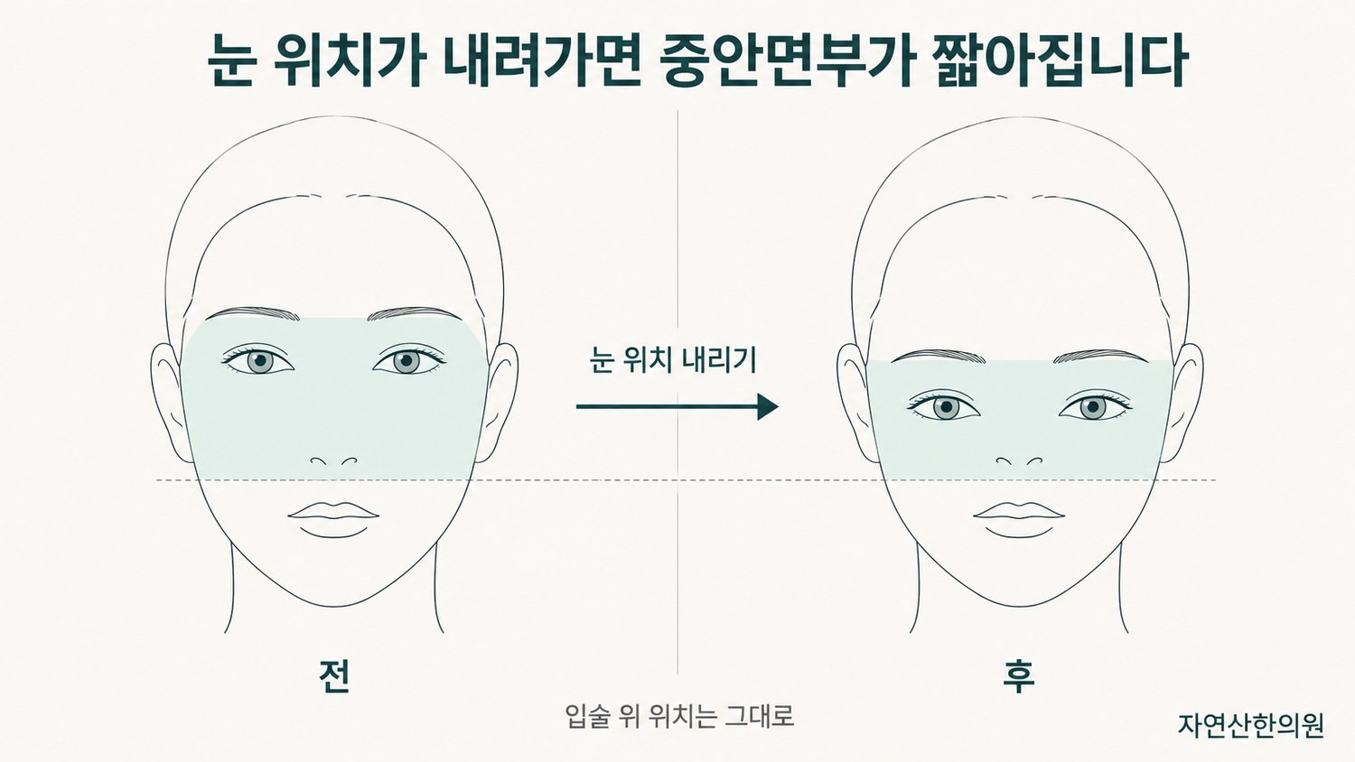 같은 이목구비에서 눈 위치가 내려갔을 때 중안면부 길이가 짧아지는 변화를 나란히 보여 준 전후 도해
