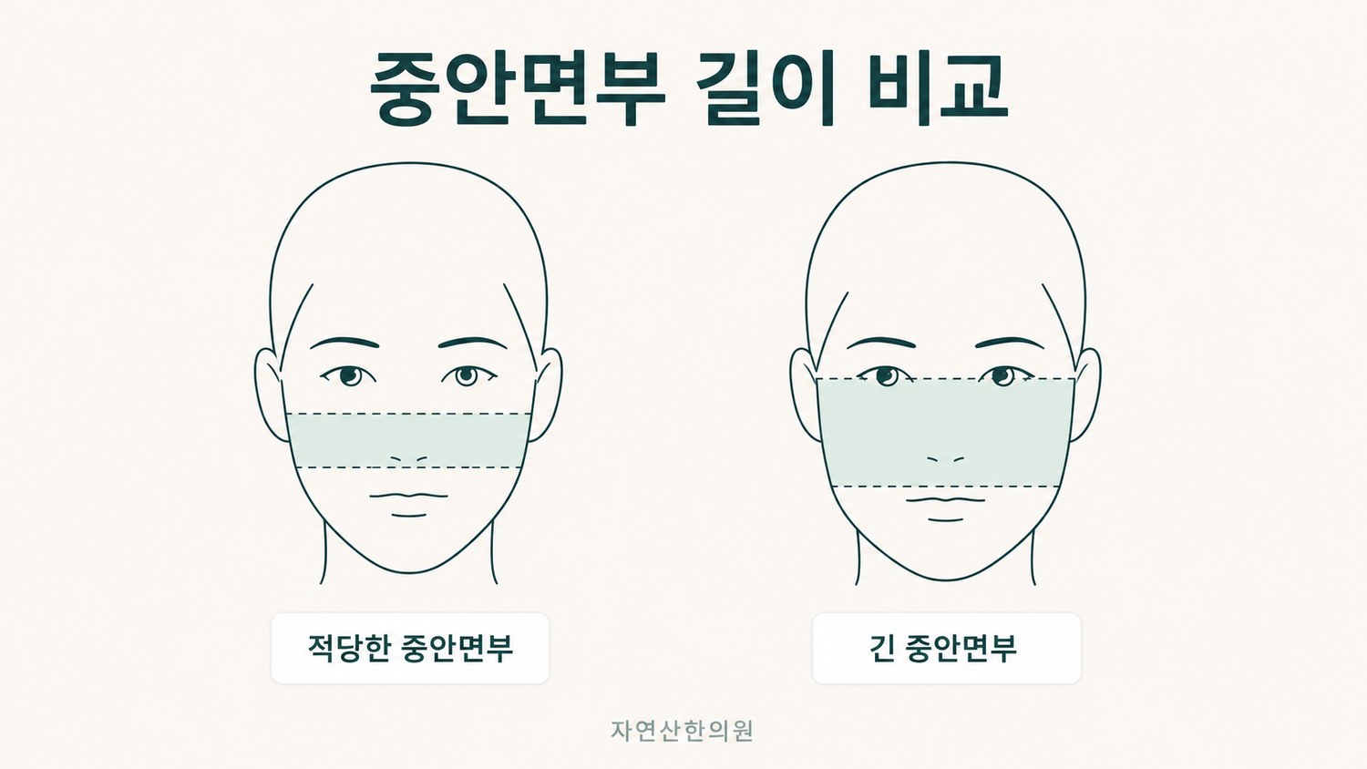 적당한 중안면부 길이의 얼굴과 긴 중안면부의 얼굴을 나란히 비교한 도해