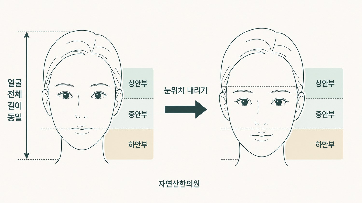 얼굴 전체 길이를 고정한 채 눈 위치를 내려 중안부 비율이 달라지는 과정을 보여주는 도해