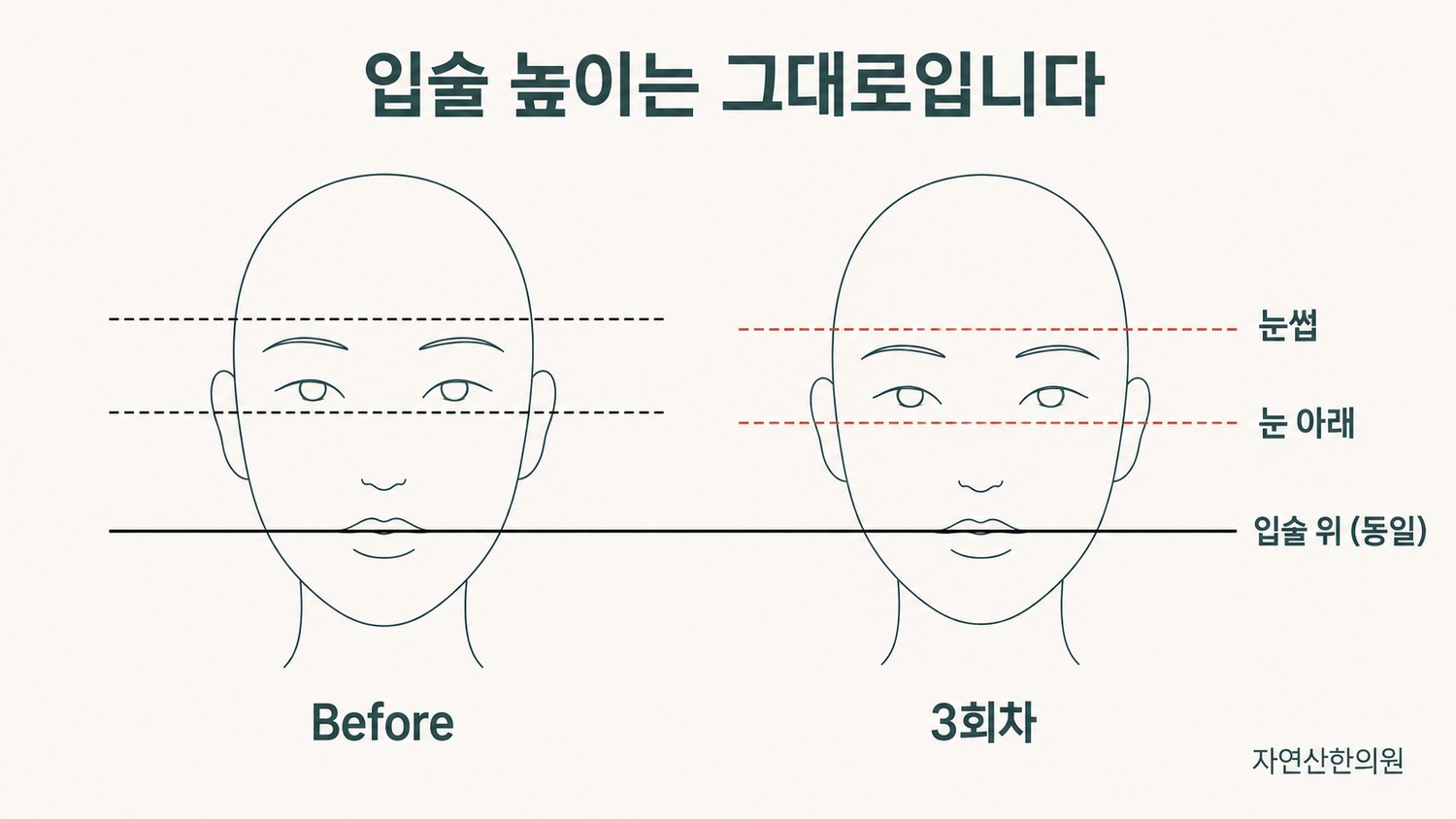 Before의 검정 기준선 3개와 3회차의 빨간 기준선 2개를 겹쳐 입술선은 고정된 채 눈썹과 눈만 내려온 것을 보여주는 도해