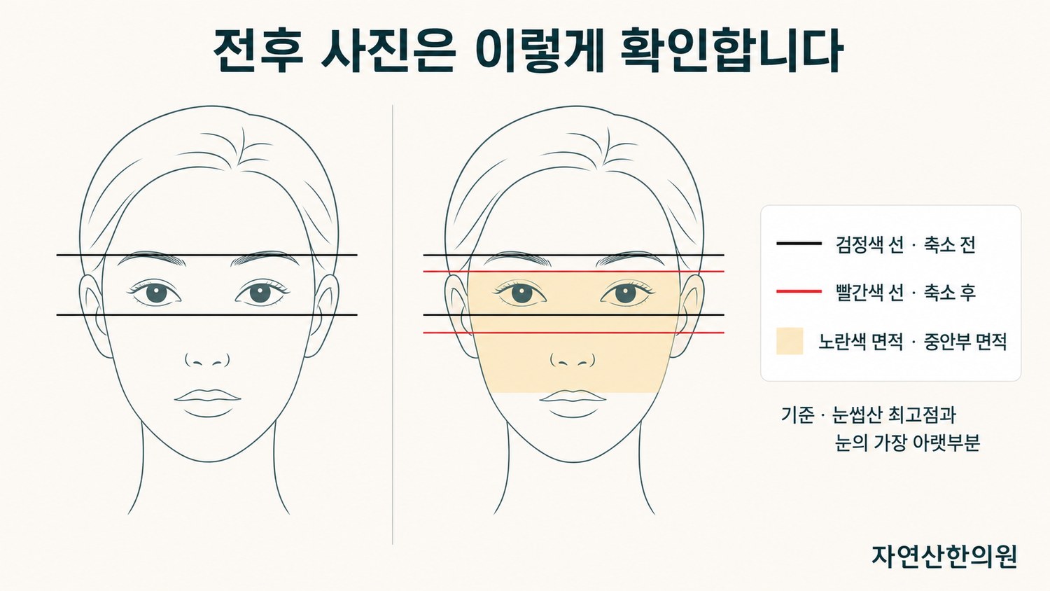 전후 얼굴 위에 눈썹산과 눈 아랫부분 기준선을 검정선과 빨간선으로 겹쳐 그리고 중안부 면적을 색으로 칠한 확인 방법 도해