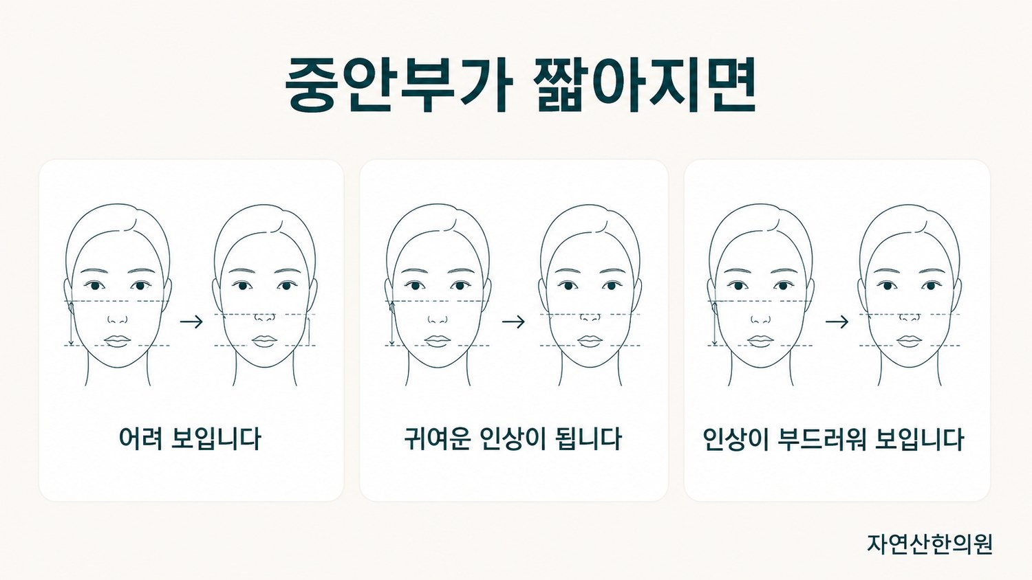 중안부 길이만 다른 동일 얼굴을 좌우로 비교하며 어려 보임·귀여움·부드러움을 표시한 도해