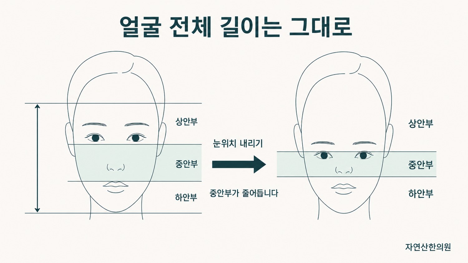얼굴 전체 길이는 고정한 채 눈 위치만 내려 상안부·중안부·하안부 비율이 달라지는 과정을 보여주는 도해