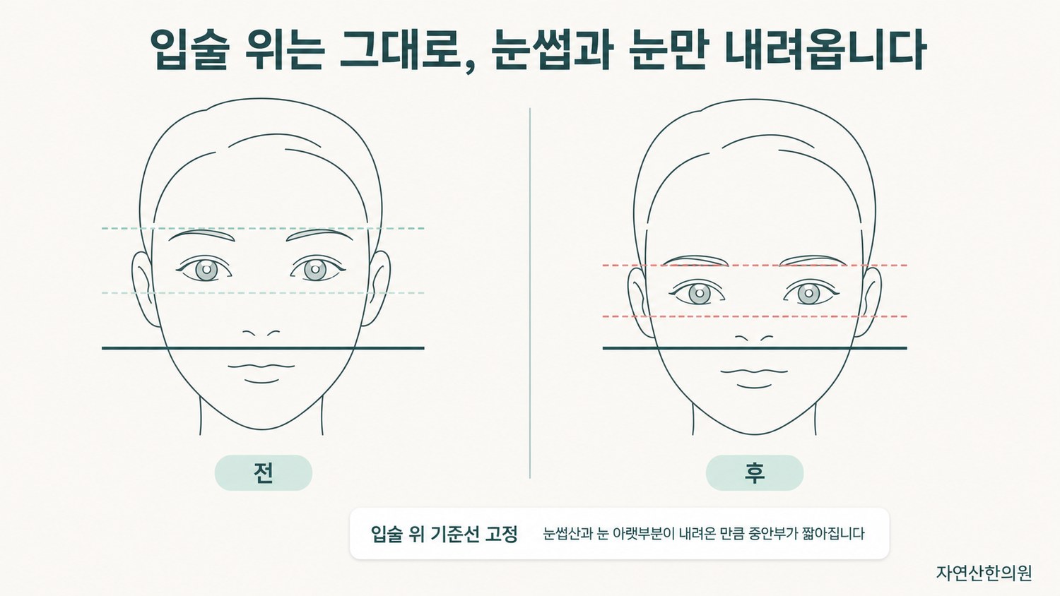 전후 얼굴에 눈썹산·눈 아랫부분·입술 위 세 기준선을 겹쳐 그려 입술 위는 고정되고 눈썹과 눈만 내려온 변화를 보여 준 도해