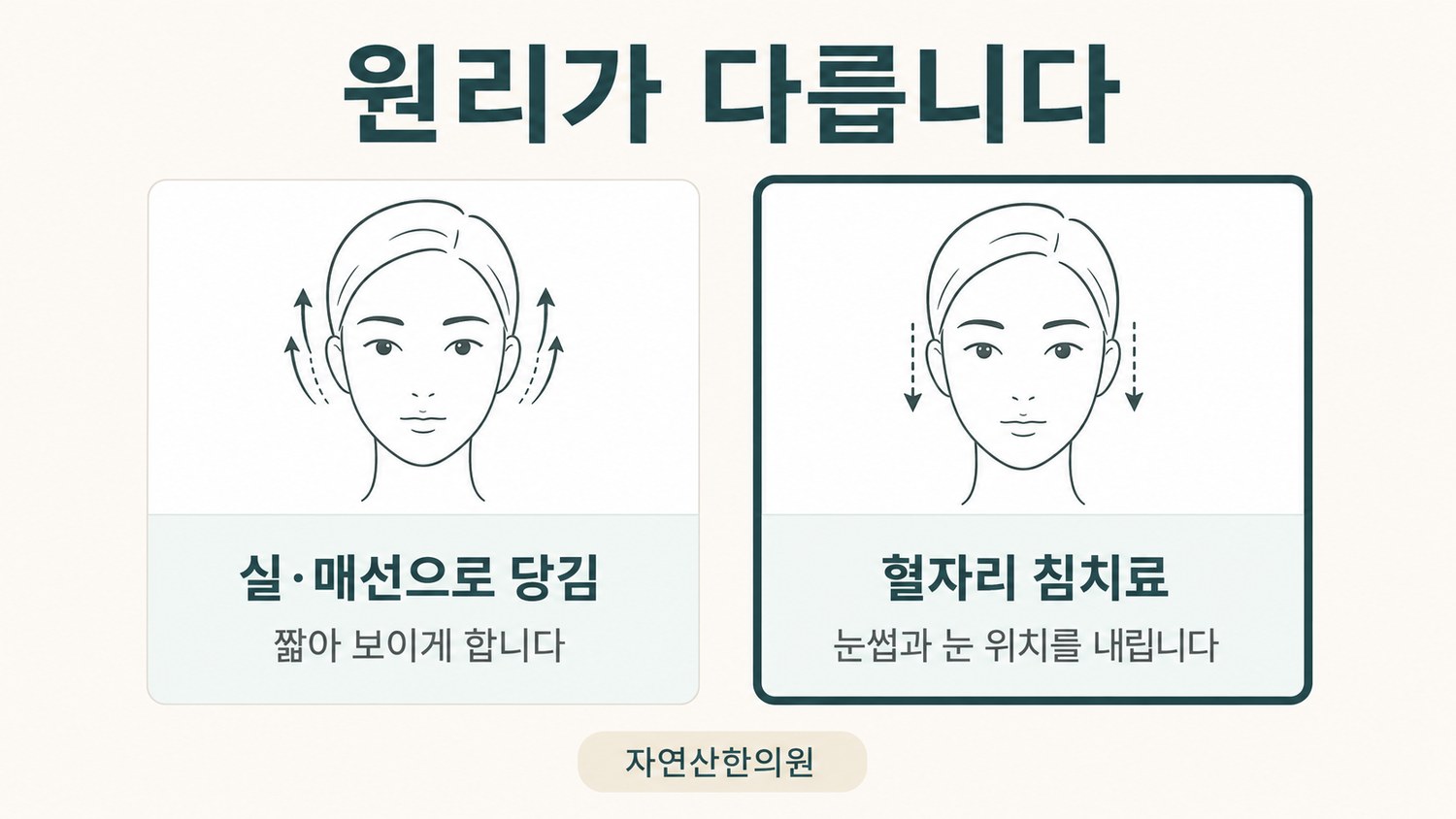 실리프팅으로 당기는 방식과 근육 조절로 눈 위치를 내리는 방식의 원리를 좌우로 비교한 도해